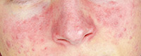 Acne rosacea