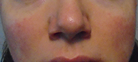 Rosacea Subtype 1 – Facial Redness (known as erythema) - Rosy JulieBC