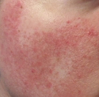 Rosacea Subtype 2 – Bumps and Pimples (known as papulopustular rosacea) - Rosy JulieBC Rosacea Subtype 2 – Bumps and Pimples (known as papulopustular rosacea) - Rosy JulieBC