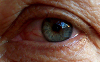 Rosacea Subtype 4 – Eye Irritation (known as ocular rosacea)